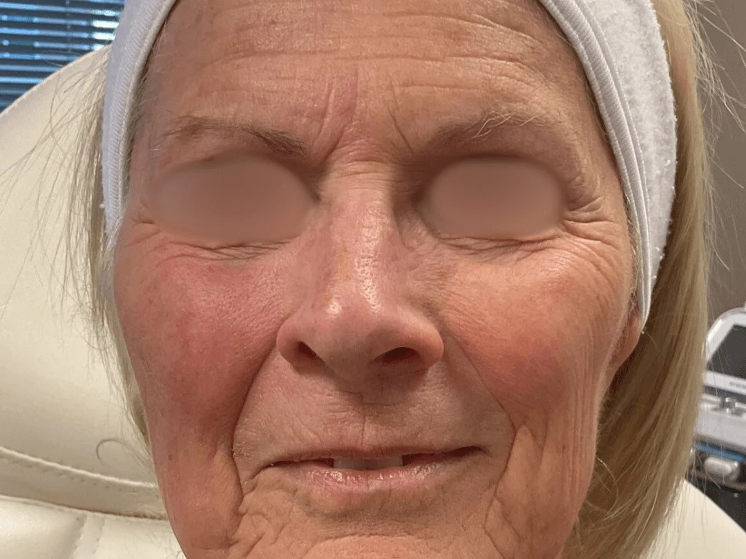 Skin Resurfacing