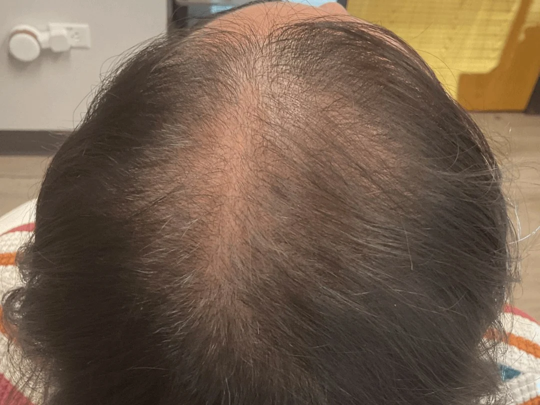 Hair Regrowth
