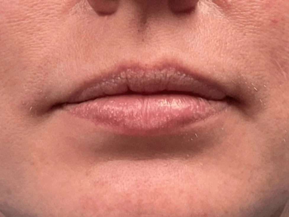 Lip Filler