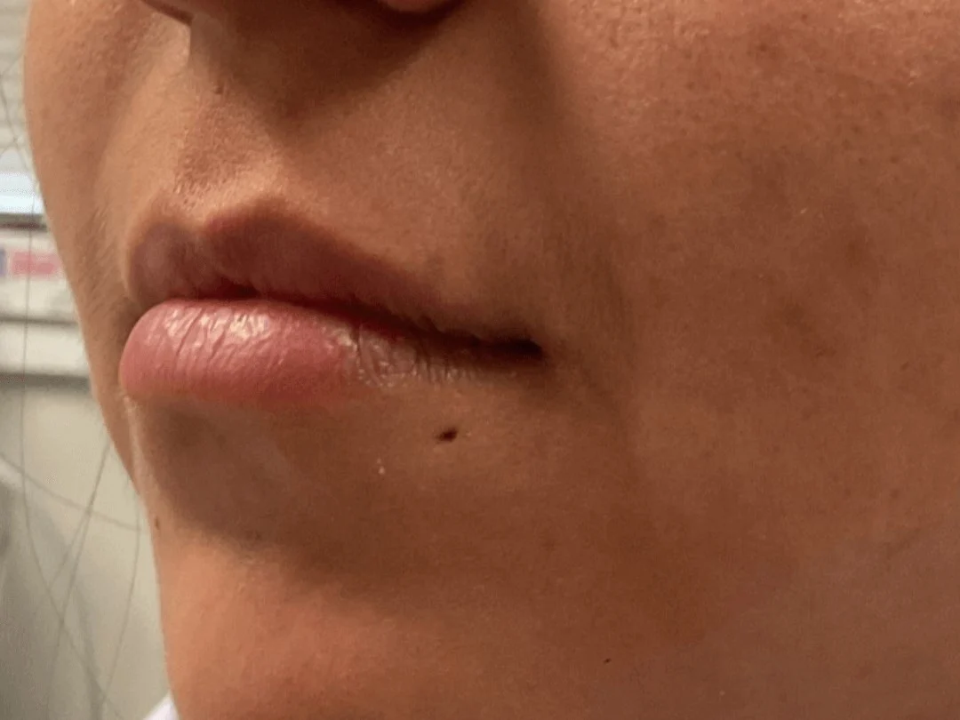 Lip Filler