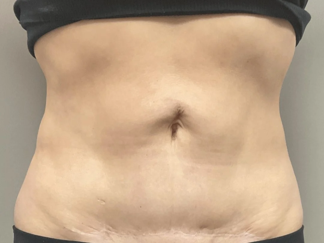 Body Contouring