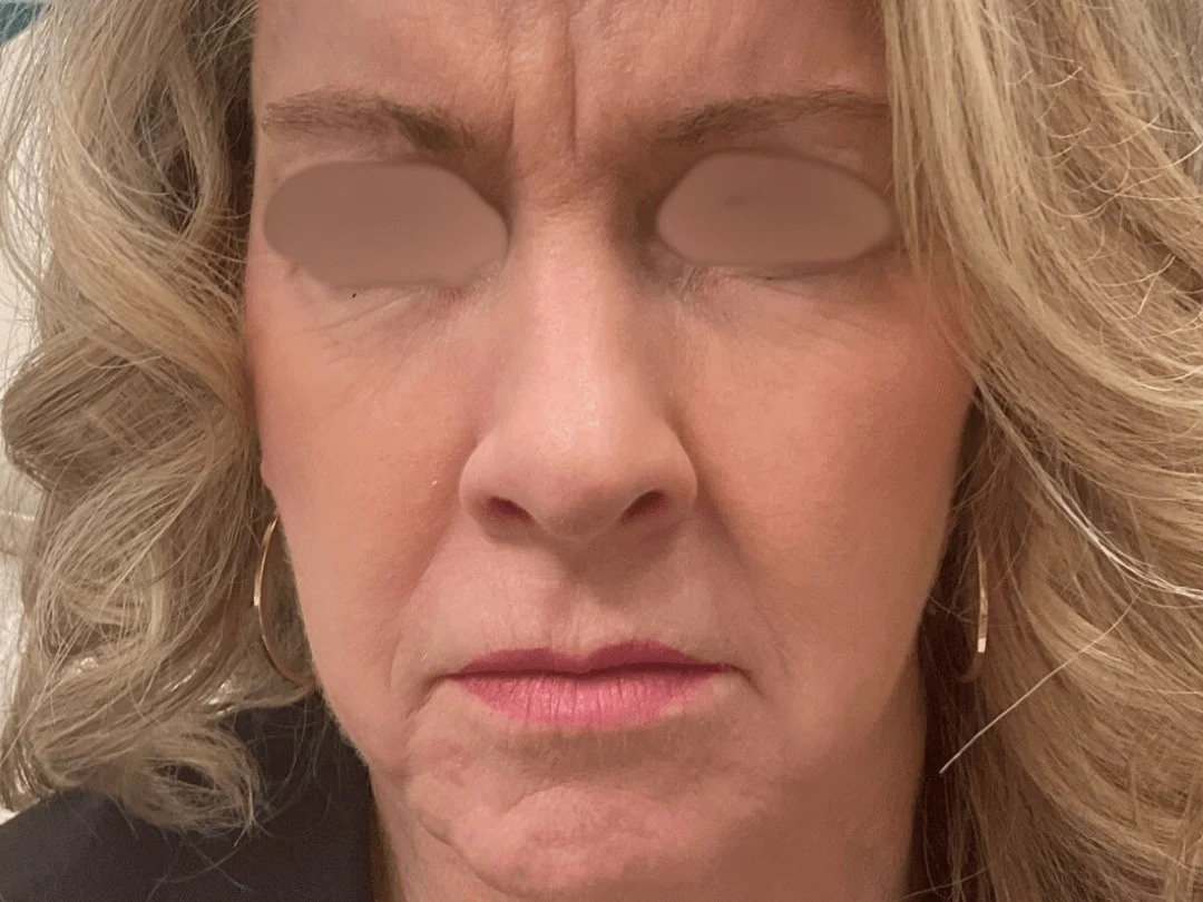 Skin Resurfacing