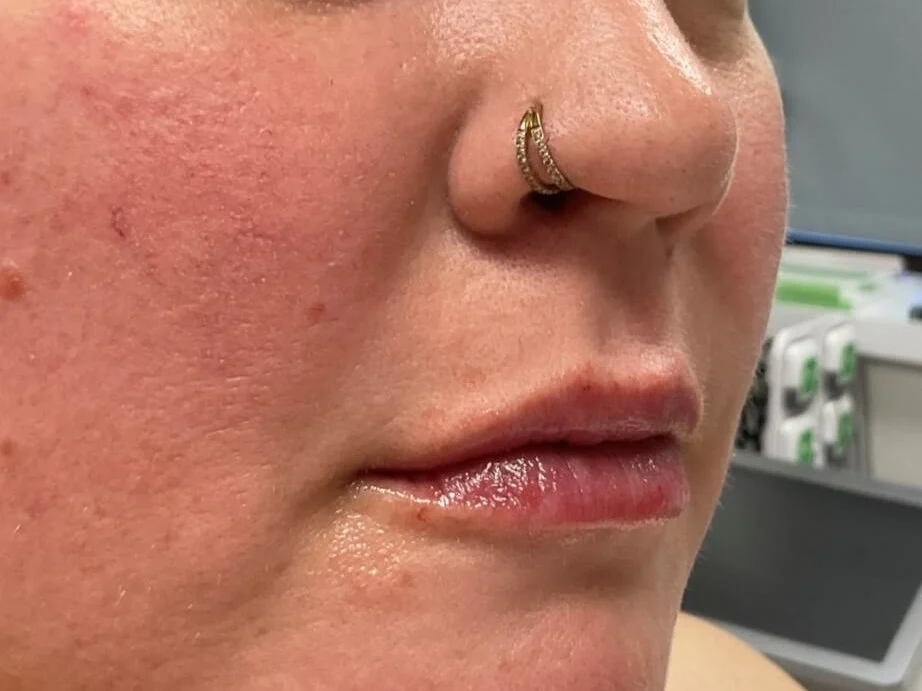  Lip Filler