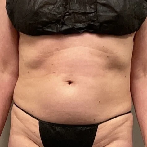 Weight Los