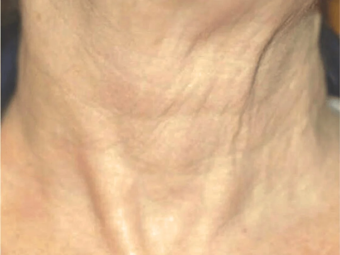 Microneedling