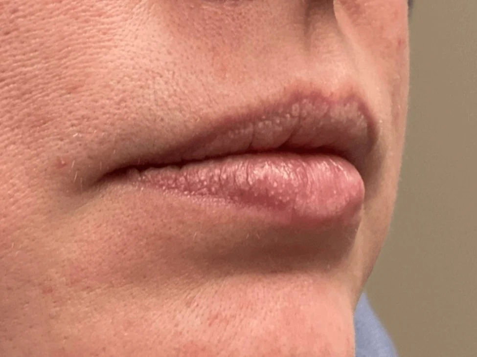 Lip Filler