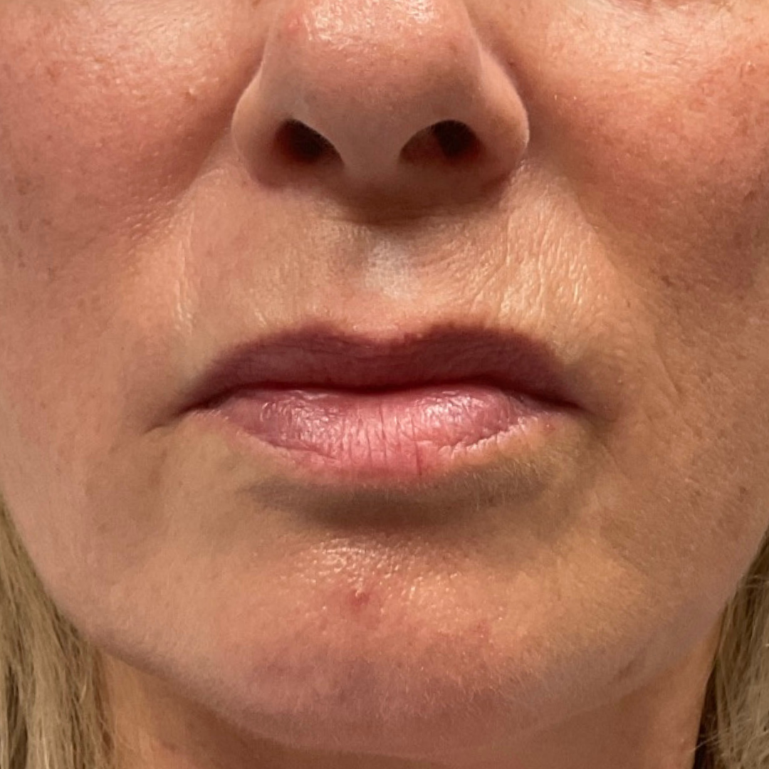 Lip Line
