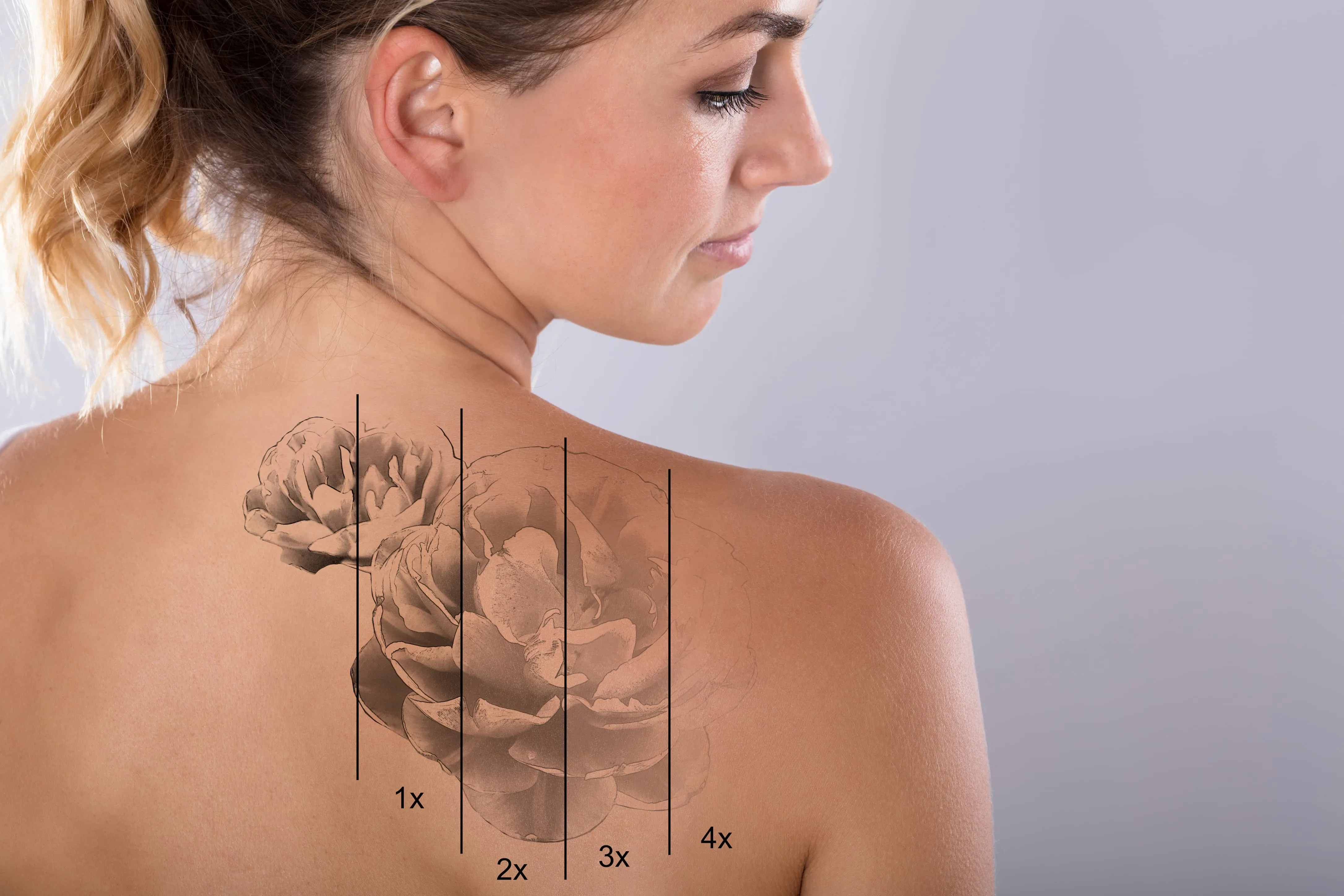 Tattoo and PMU Removal