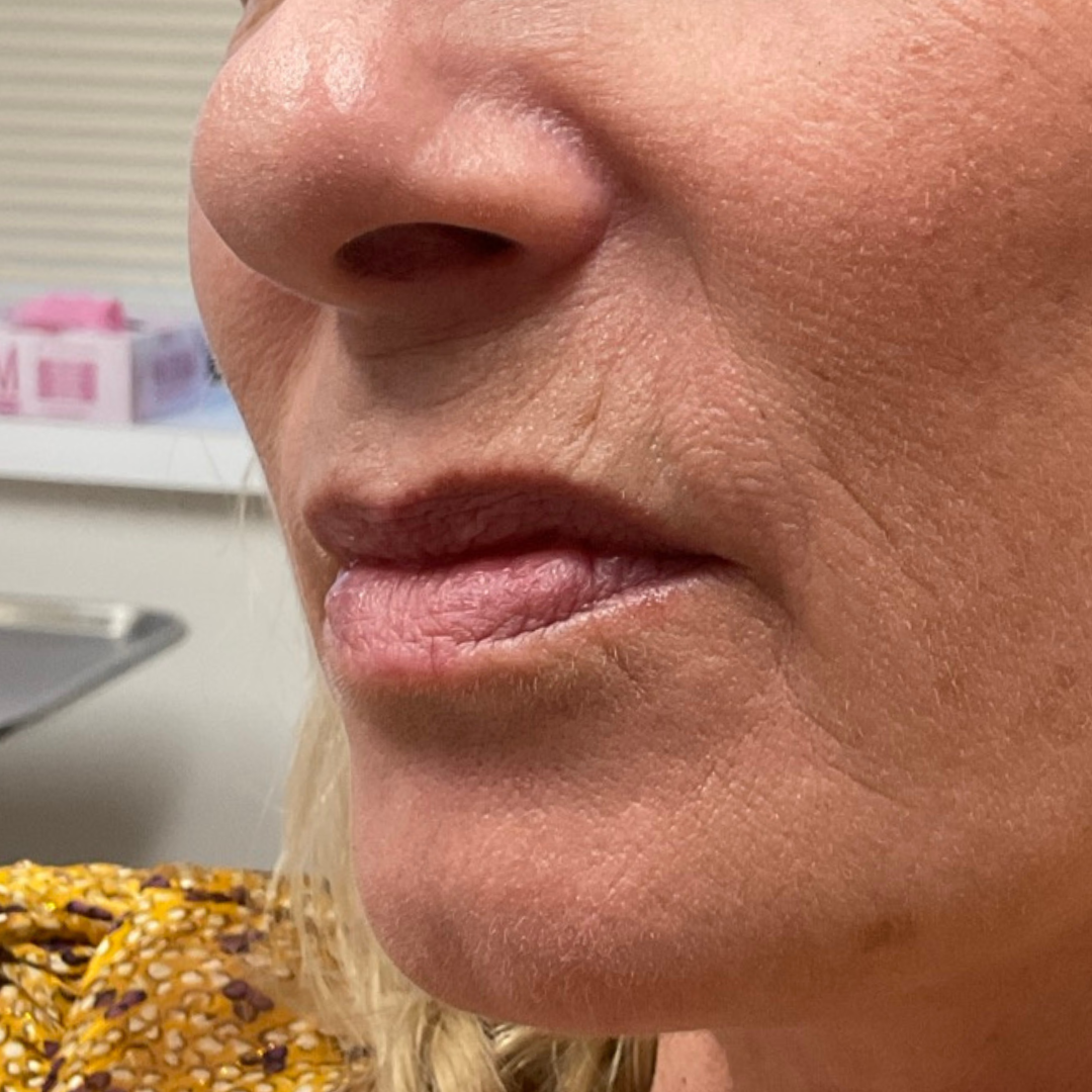 Lip Line
