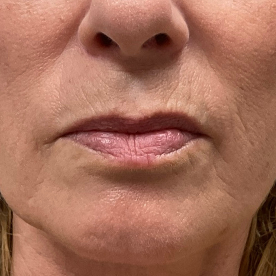 Lip Line