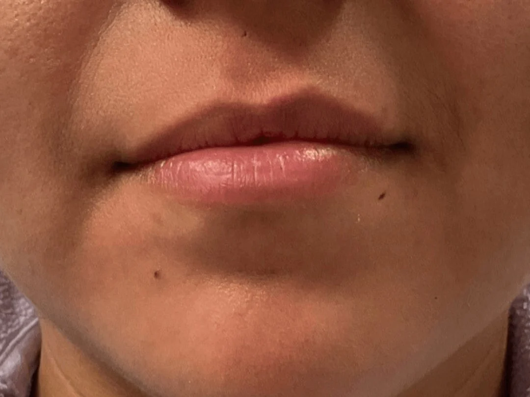 Lip Filler