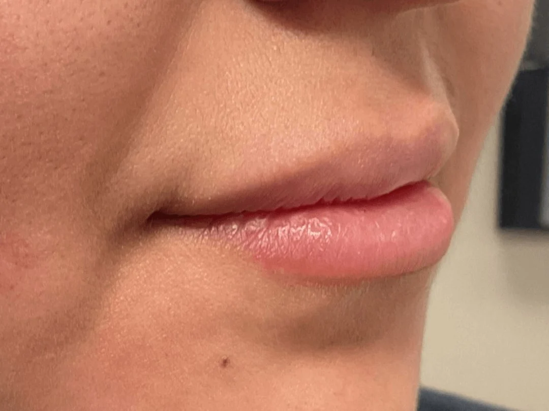 Lip Filler