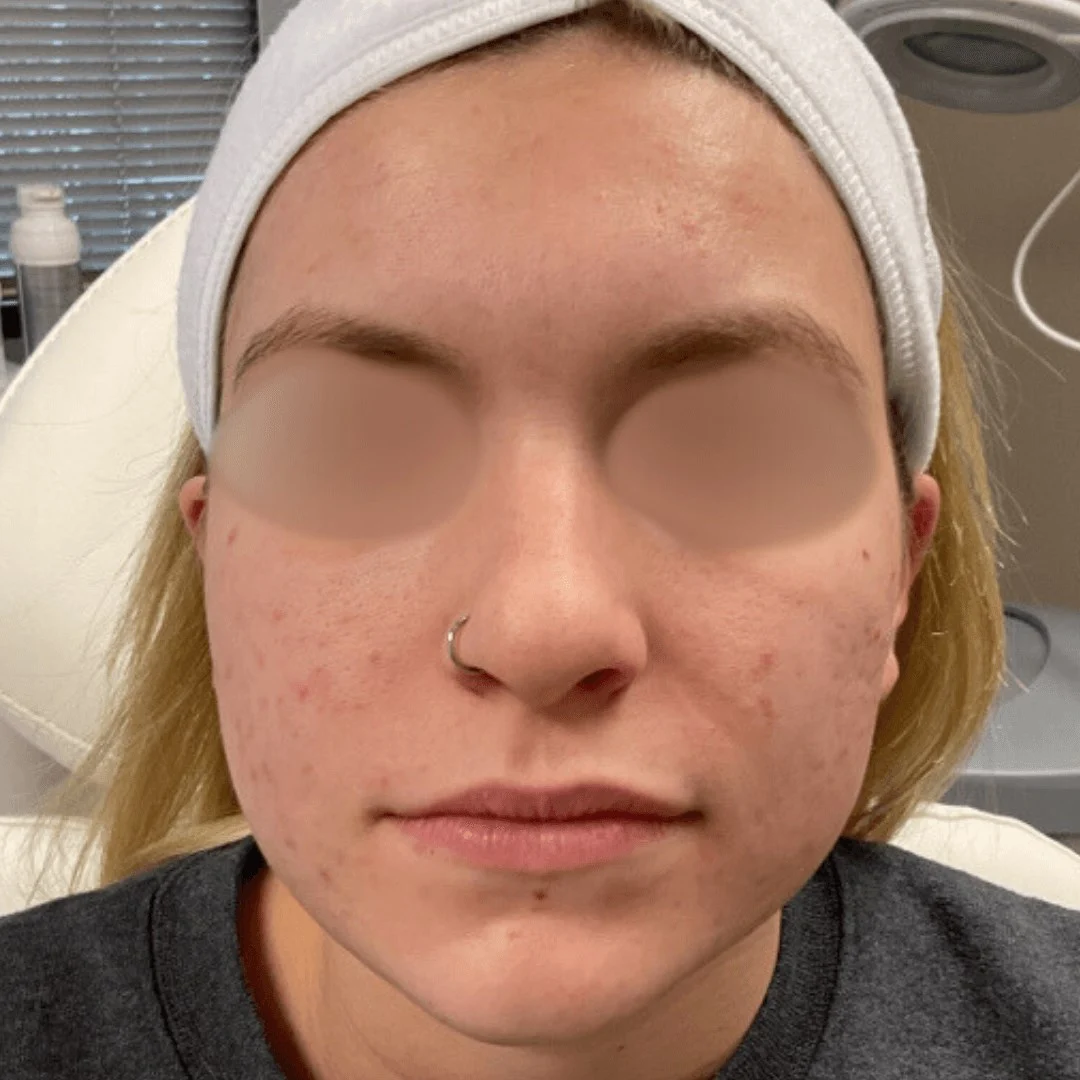 Acne Treatment 