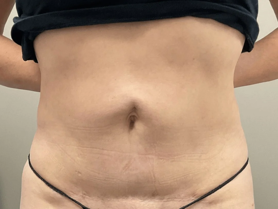 Body Contouring
