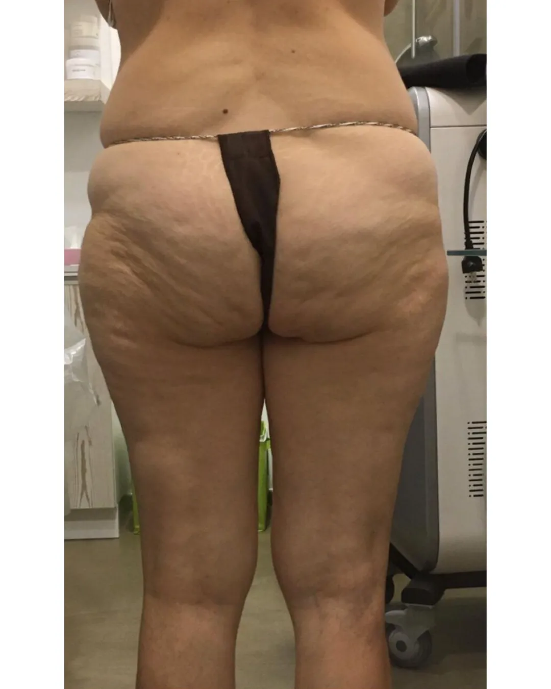 Cellulite Reduction