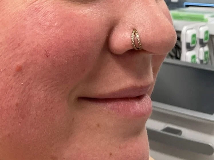  Lip Filler