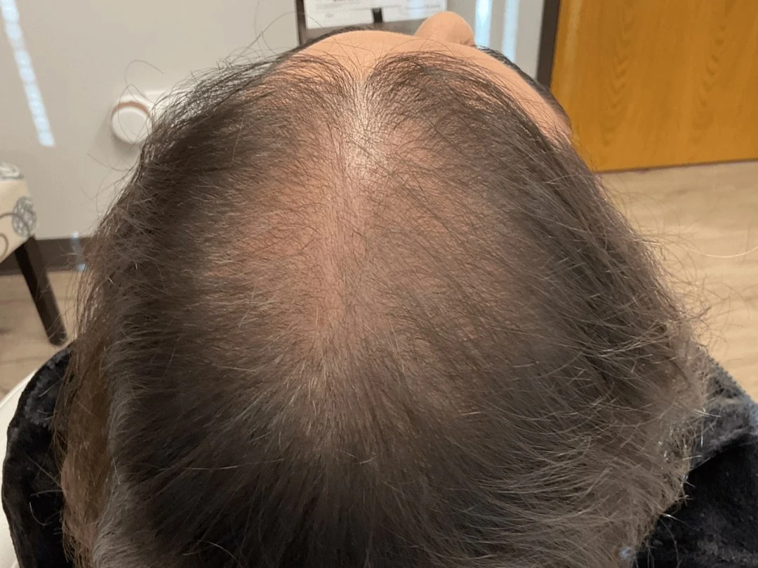 Hair Regrowth