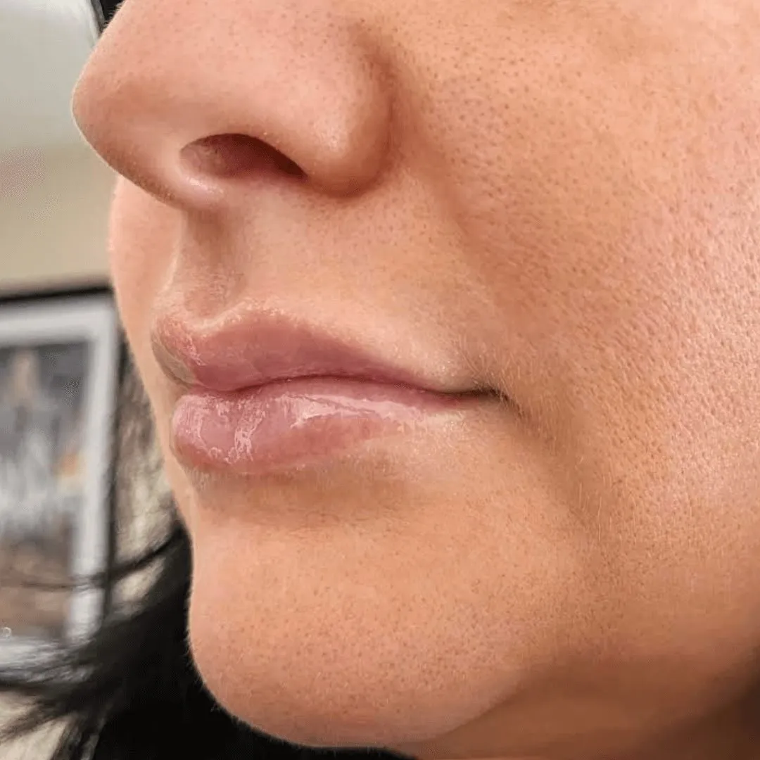  Lip Filler