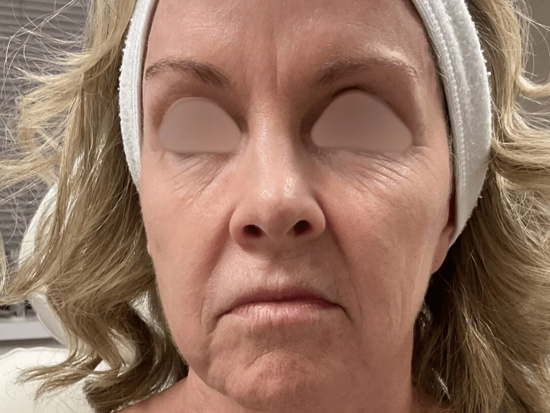 Skin Resurfacing