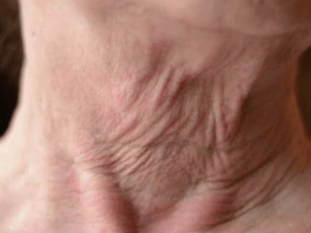 Microneedling