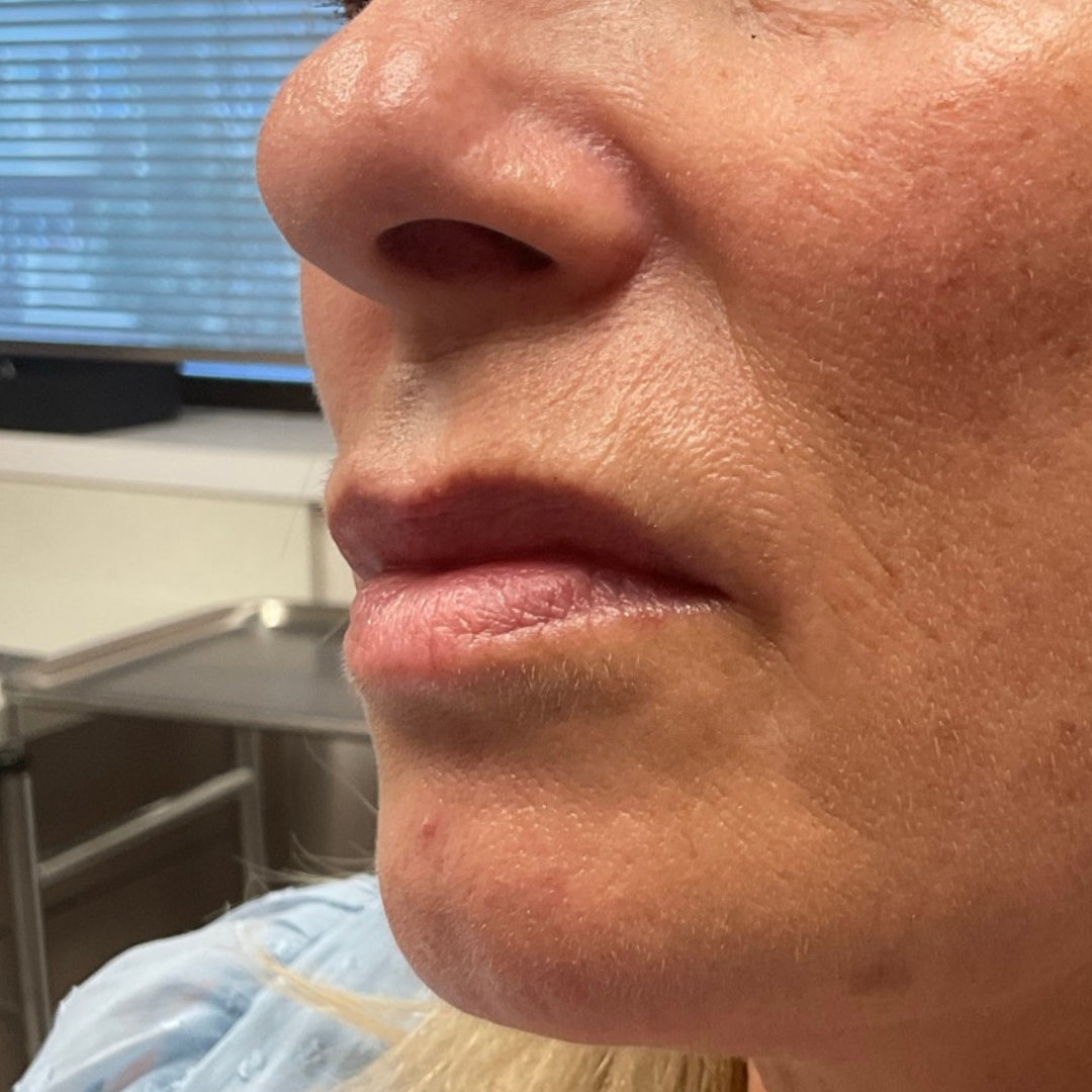 Lip Line