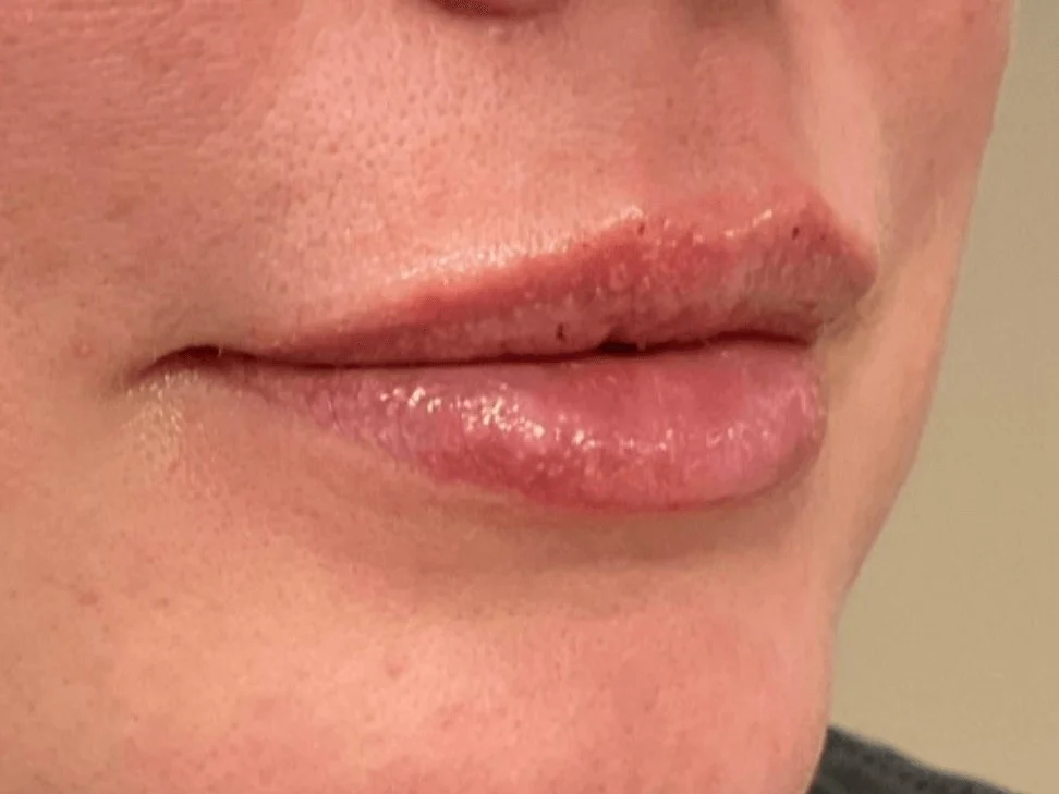 Lip Filler