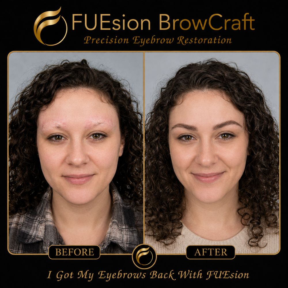 Full brow reconstruction before and after — FUEsion BrowCraft