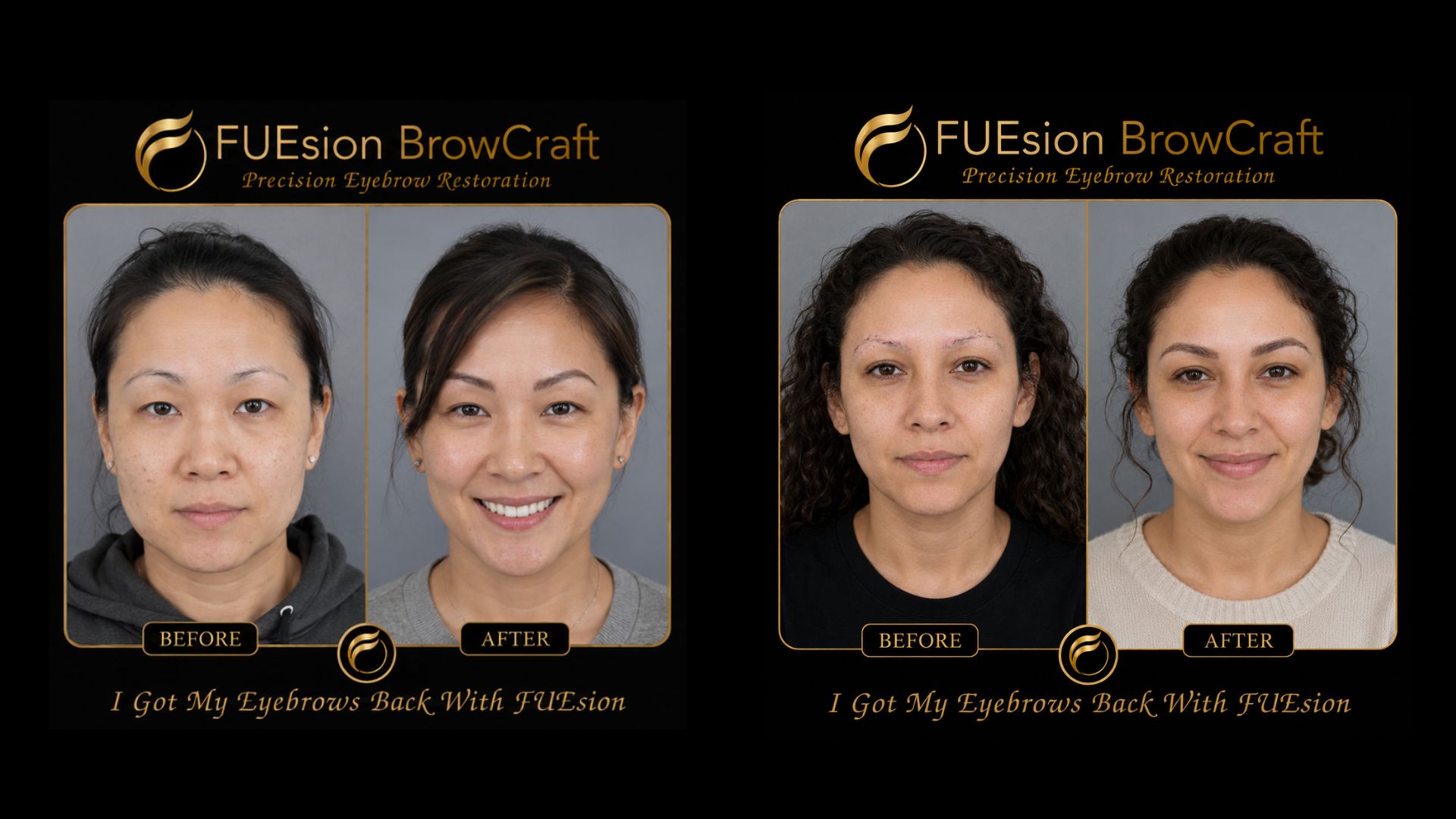 Eyebrow transplant before and after — FUEsion BrowCraft crown brow restoration