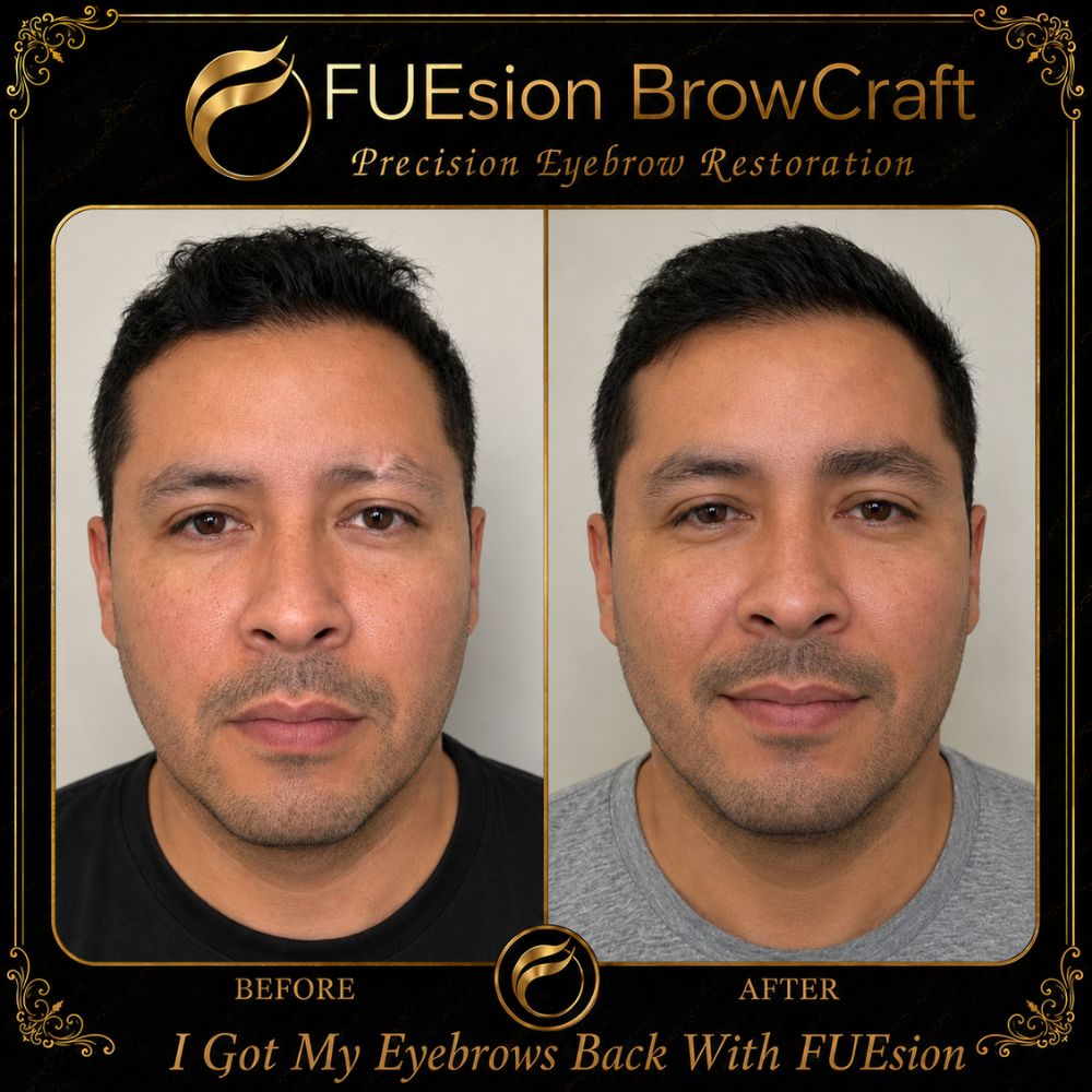 Men's brow density restoration before and after — FUEsion BrowCraft