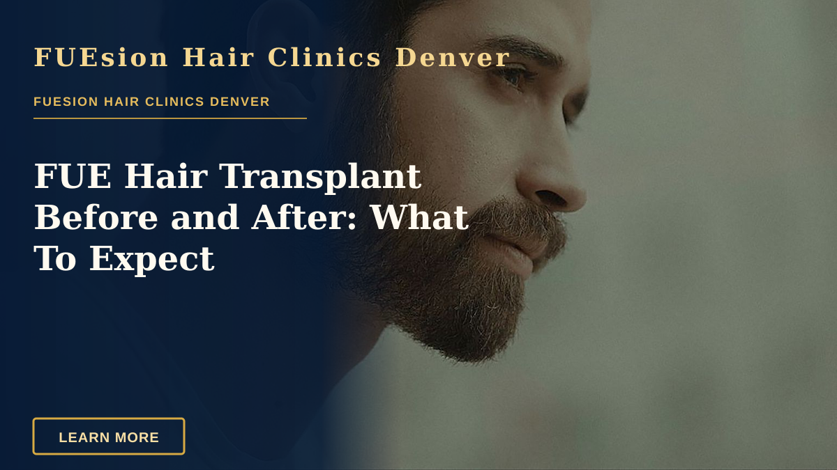 FUE Hair Transplant Before and After: What To Expect — Side profile of a bearded man in an artistic setting, capturing a thoughtful expression.