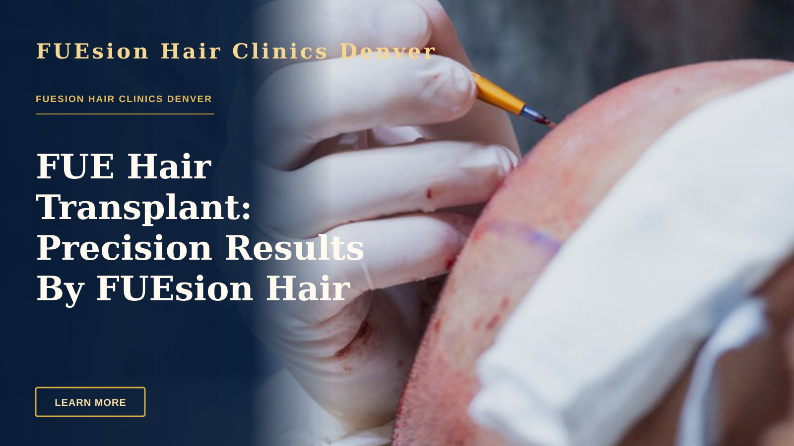 FUE Hair Transplant: Precision Results By FUEsion Hair Clinics