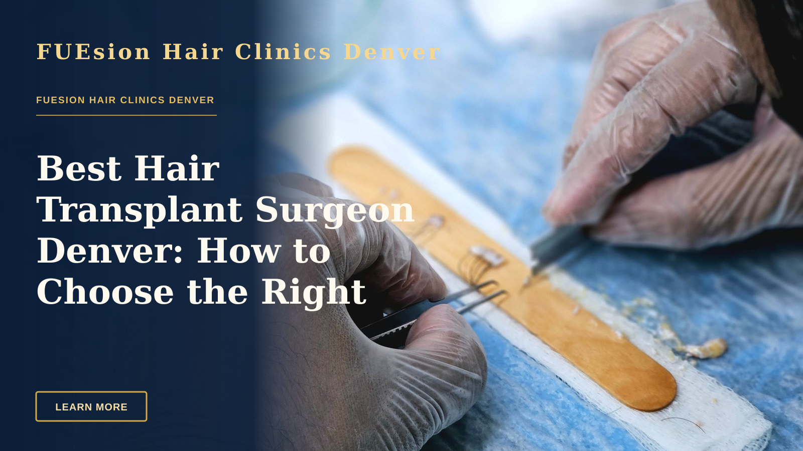 Best Hair Transplant Surgeon Denver: How to Choose the Right Expert — Close-up of surgeons preparing hair grafts for transplantation, demonstrating precise skills.