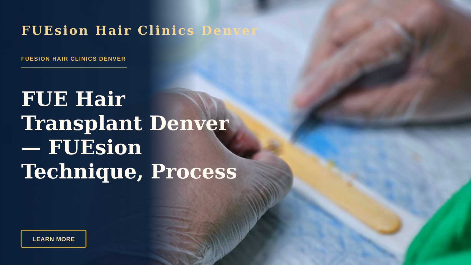 FUE Hair Transplant Denver — FUEsion Technique, Process & Next Steps