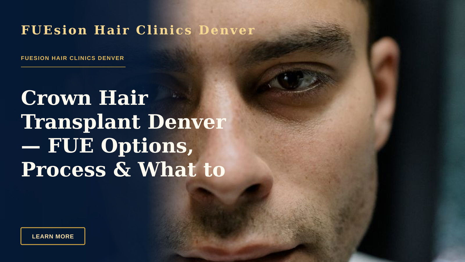 Crown Hair Transplant Denver — FUE Options, Process & What to Expect