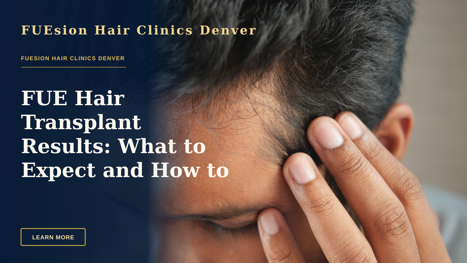 FUE Hair Transplant Results: What to Expect and How to Evaluate — Close-up of a man's hand touching his head in contemplation. Neutral tones and soft lighting.