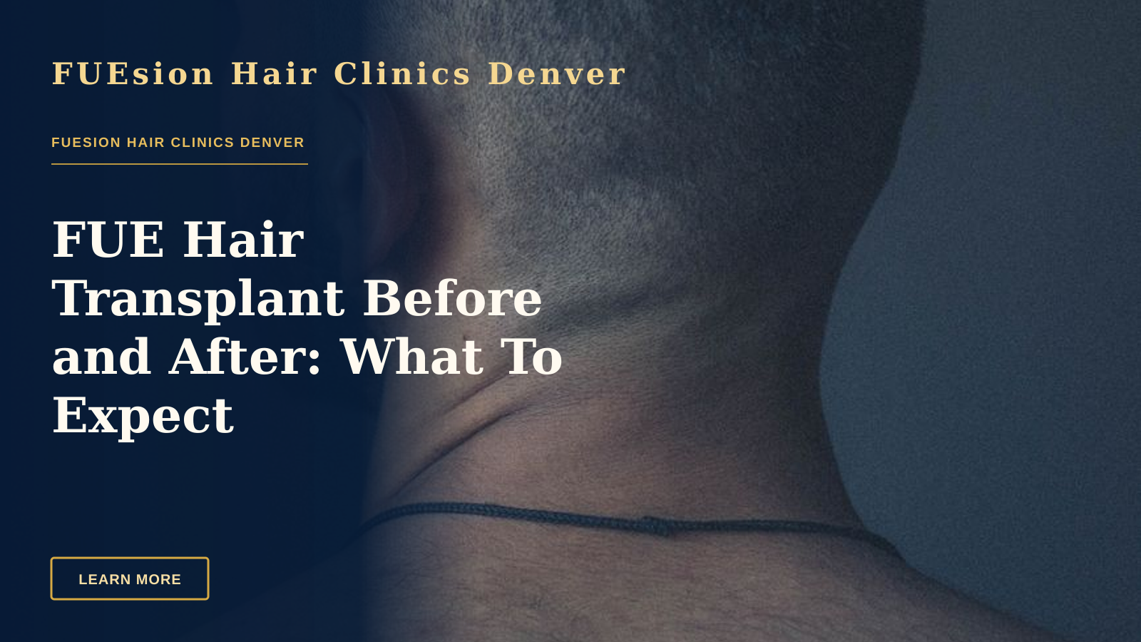 FUE Hair Transplant Before and After: What To Expect — Back view unrecognizable bearded brunet with naked torso standing against dark gray wall and looking away