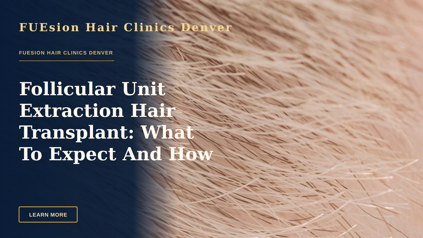 Follicular Unit Extraction Hair Transplant: What To Expect And How To Evaluate