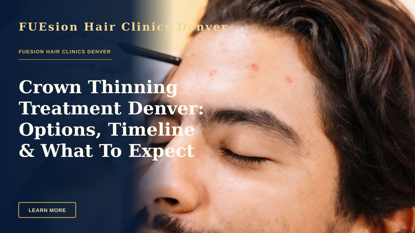Crown Thinning Treatment Denver: Options, Timeline & What To Expect