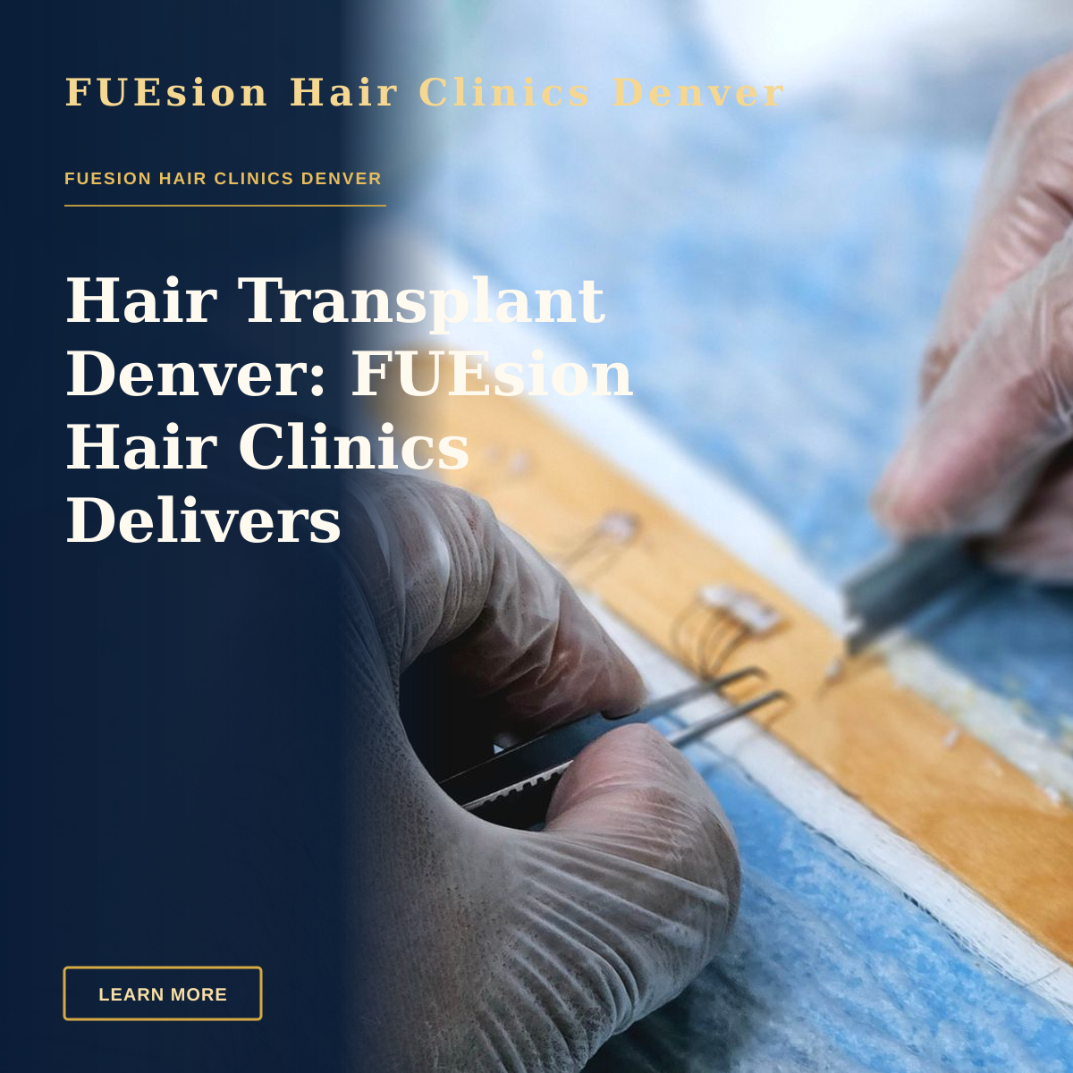 Hair Transplant Denver: FUEsion Hair Clinics Delivers Excellence — Close-up of surgeons preparing hair grafts for transplantation, demonstrating precise skills.