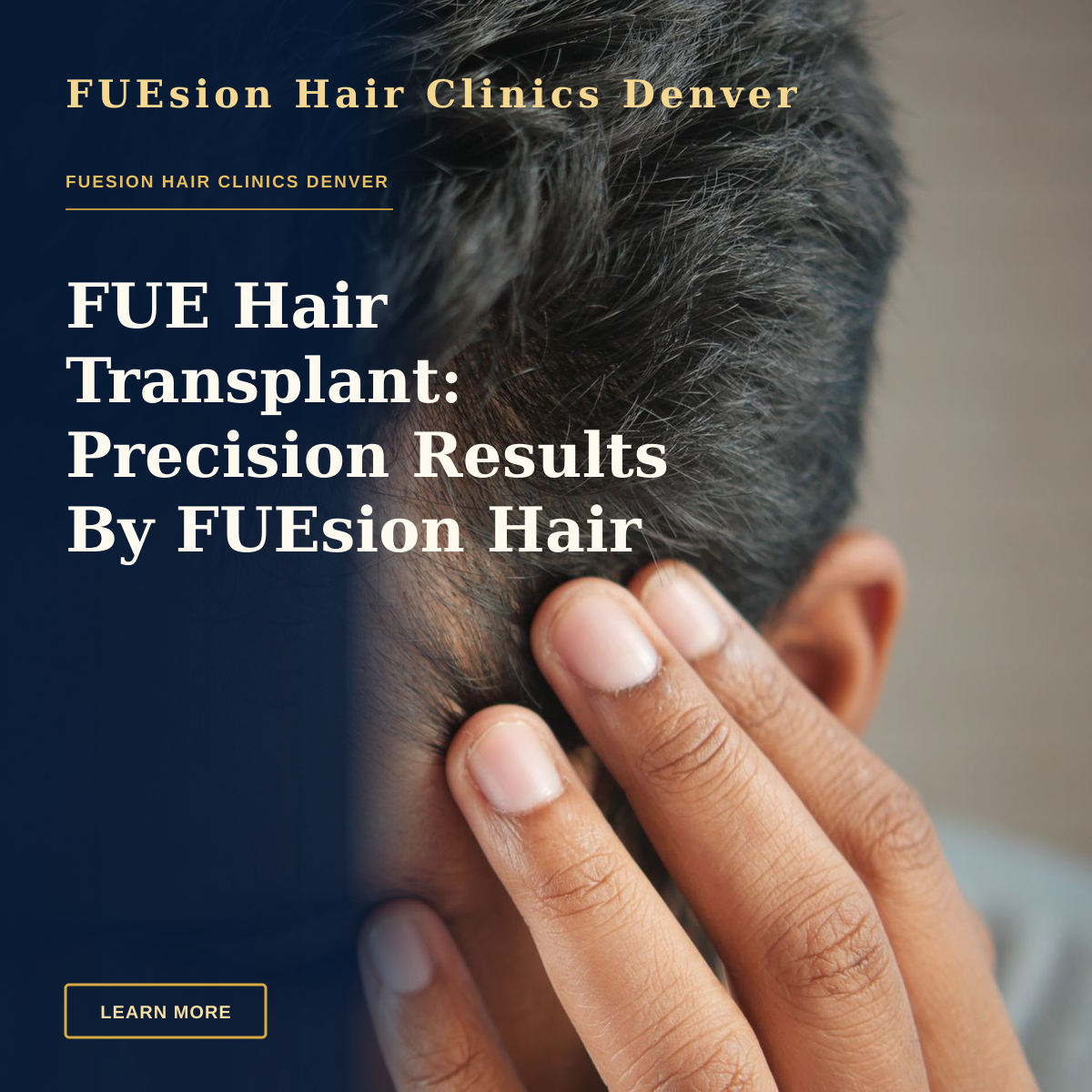 FUE Hair Transplant: Precision Results By FUEsion Hair Clinics — Close-up of a man's hand touching his head in contemplation. Neutral tones and soft lighting.