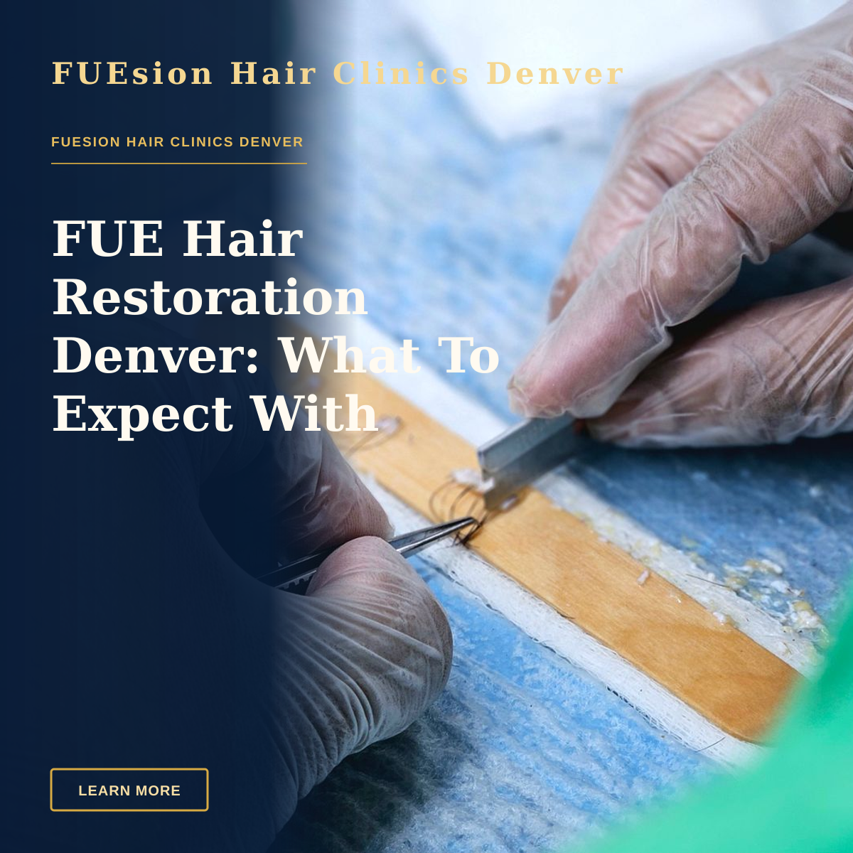 FUE Hair Restoration Denver: What To Expect With FUEsion — Detailed view of a hair transplant procedure with gloved hands holding surgical tools indoors.