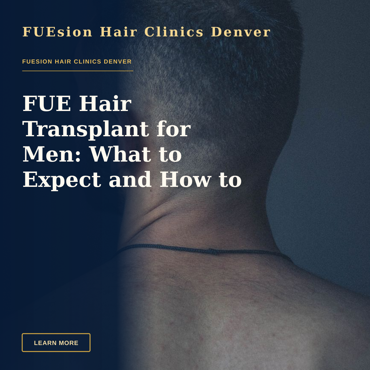 FUE Hair Transplant for Men: What to Expect and How to Choose — Back view unrecognizable bearded brunet with naked torso standing against dark gray wall and looking away