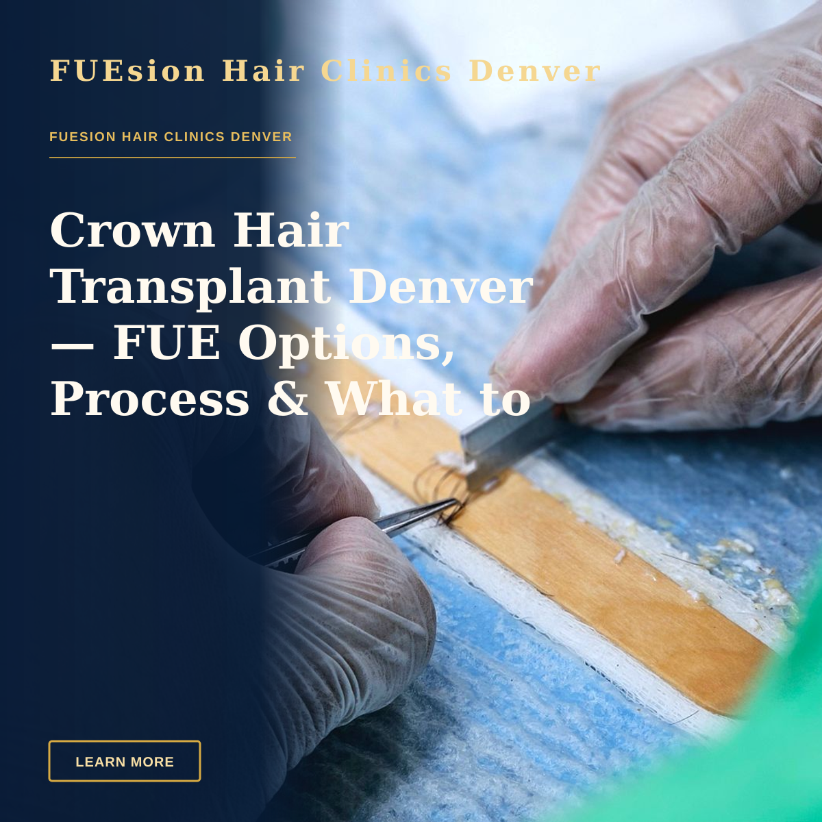 Crown Hair Transplant Denver — FUE Options, Process & What to Expect — Detailed view of a hair transplant procedure with gloved hands holding surgical tools indoors.