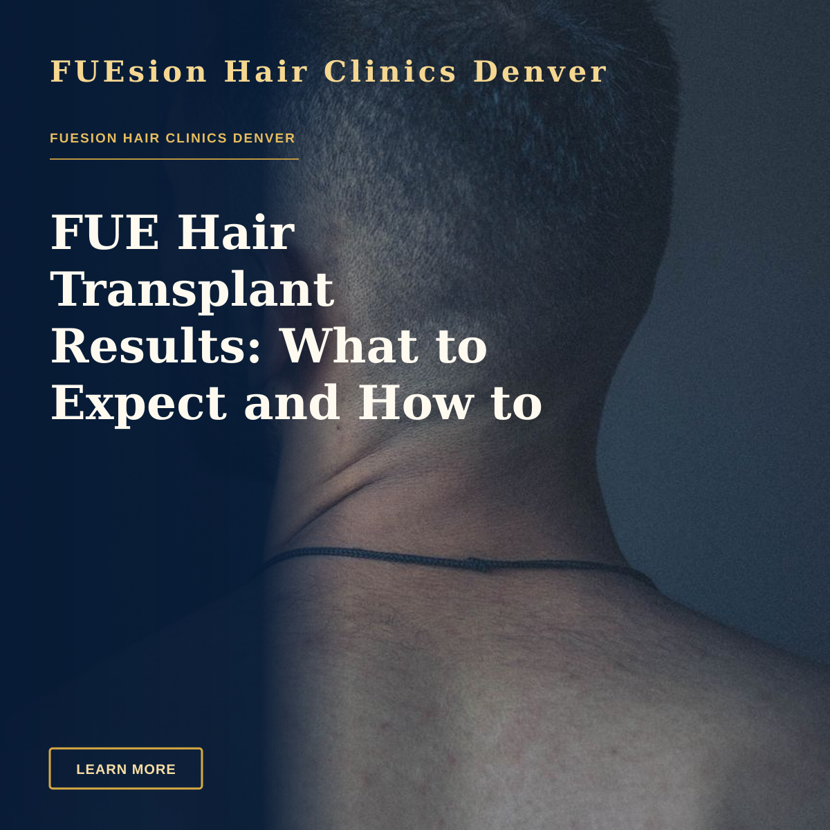 FUE Hair Transplant Results: What to Expect and How to Evaluate — Back view unrecognizable bearded brunet with naked torso standing against dark gray wall and looking away