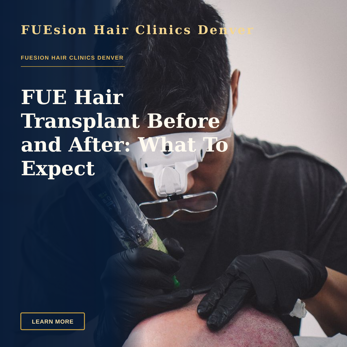 FUE Hair Transplant Before and After: What To Expect — A skilled tattoo artist performing scalp micropigmentation on a client's head.