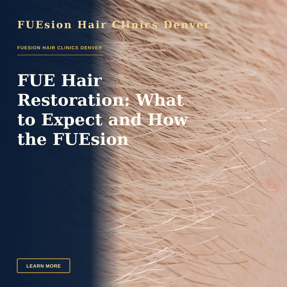 FUE Hair Restoration: What to Expect and How the FUEsion Approach Works — Full frame closeup of skin with short brown and fair hairs on surface