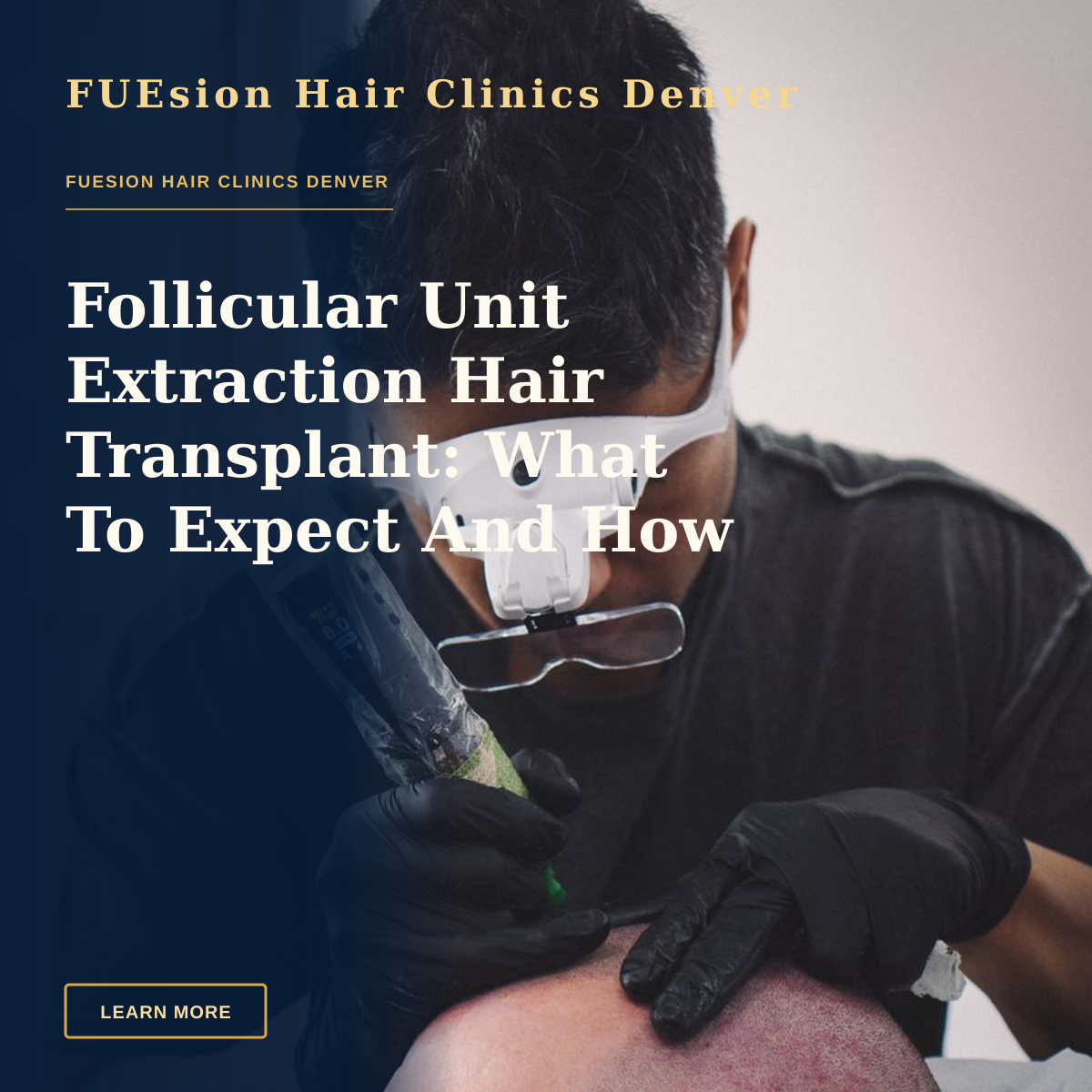 Follicular Unit Extraction Hair Transplant: What To Expect And How To Evaluate — A skilled tattoo artist performing scalp micropigmentation on a client's head.