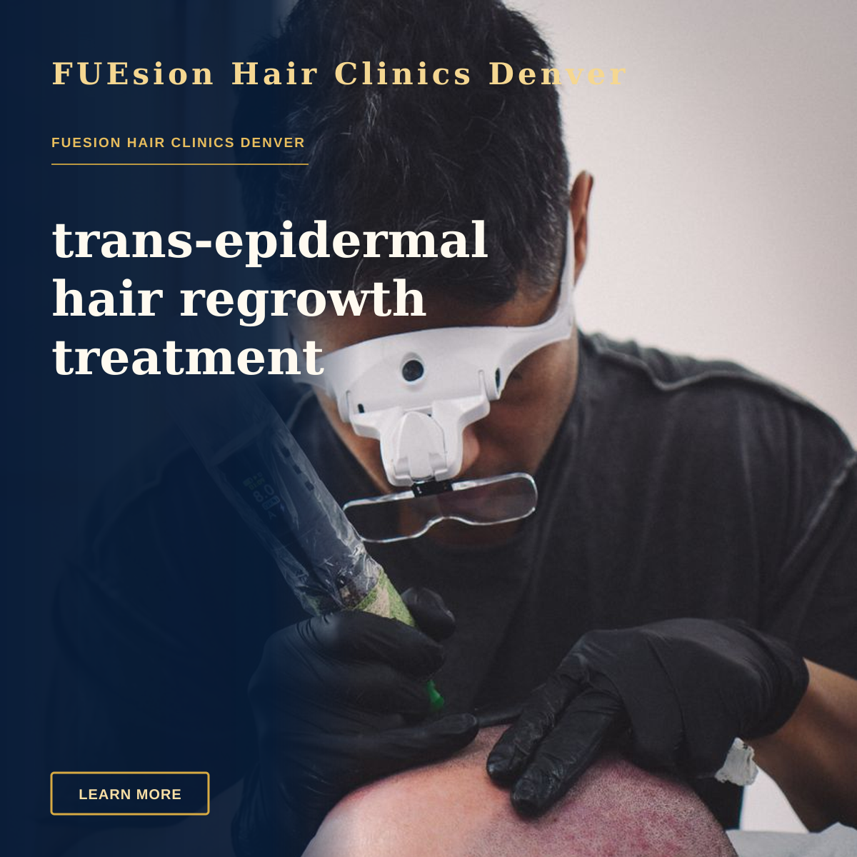 trans-epidermal hair regrowth treatment — A skilled tattoo artist performing scalp micropigmentation on a client's head.