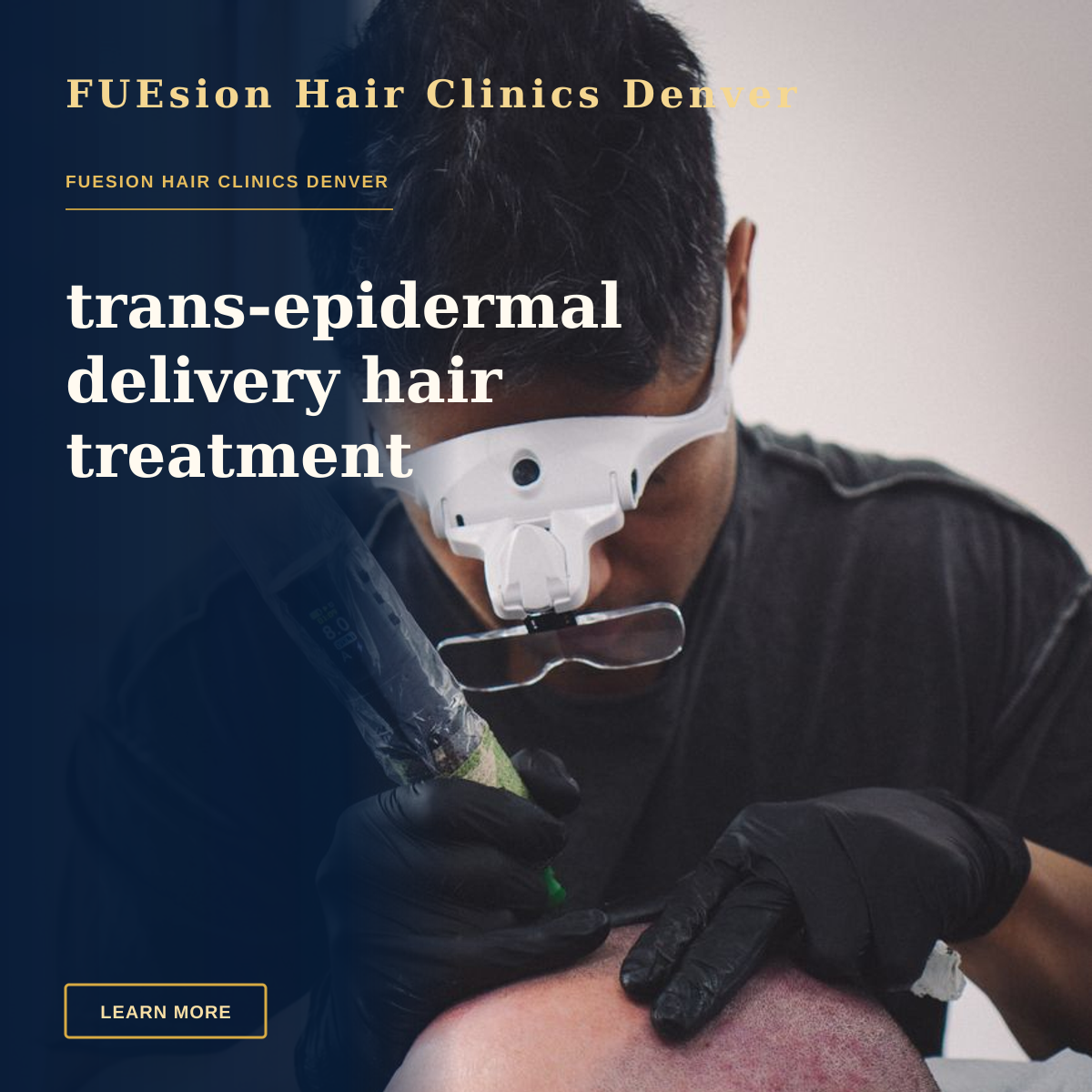 trans-epidermal delivery hair treatment — A skilled tattoo artist performing scalp micropigmentation on a client's head.