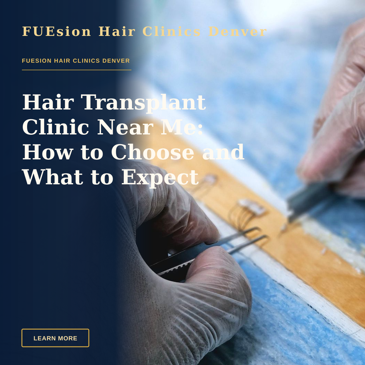 Hair Transplant Clinic Near Me: How to Choose and What to Expect — Close-up of surgeons preparing hair grafts for transplantation, demonstrating precise skills.